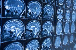 How Chandler Volta Personal Injury Lawyers Can Help After a Brain Injury Caused by a Motorcycle Accident in Charlotte, NC
